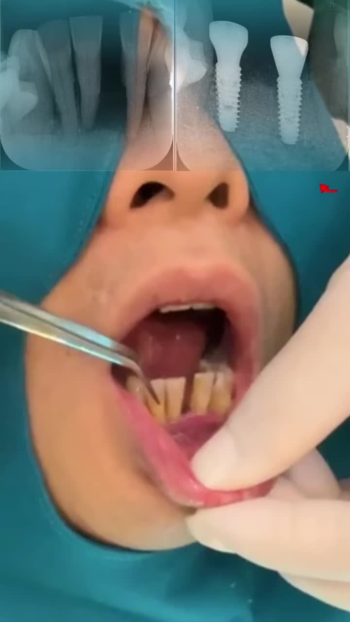 Nhổ răng xong – cắm Implant ngay có phải là lựa chọn tốt nhất?
