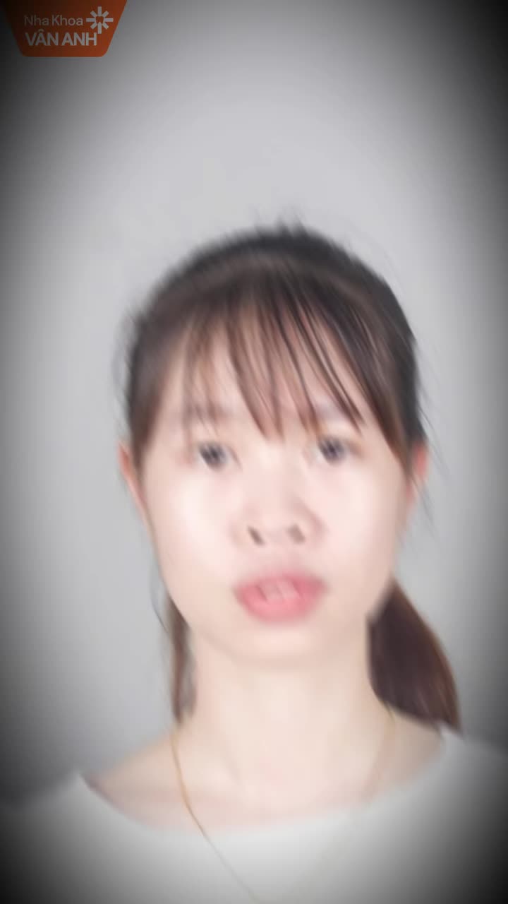 Tình trạng: Răng hô kèm chen chúc hai hàm, sai khớp cắn
