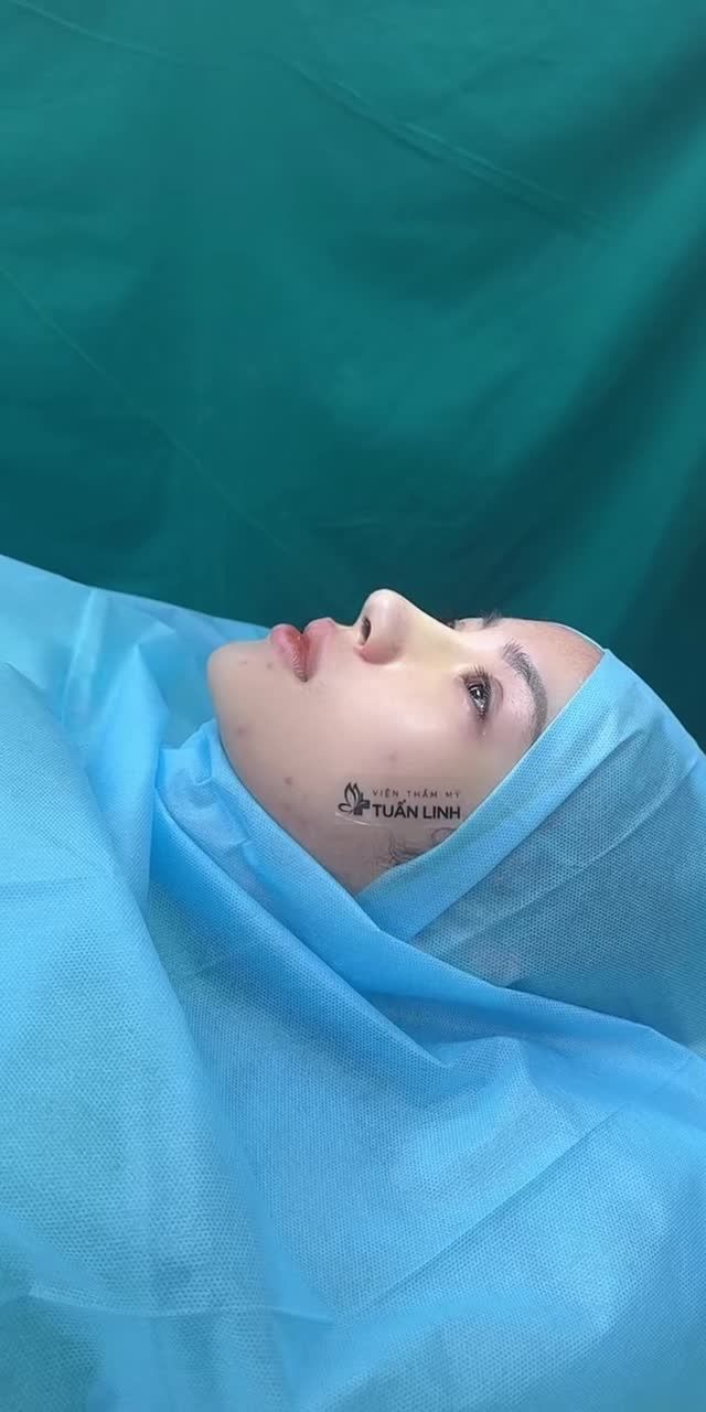 CA NÂNG MŨI BỌC SỤN VÀO FORM NGAY KHI MỚI HOÀN THÀNH