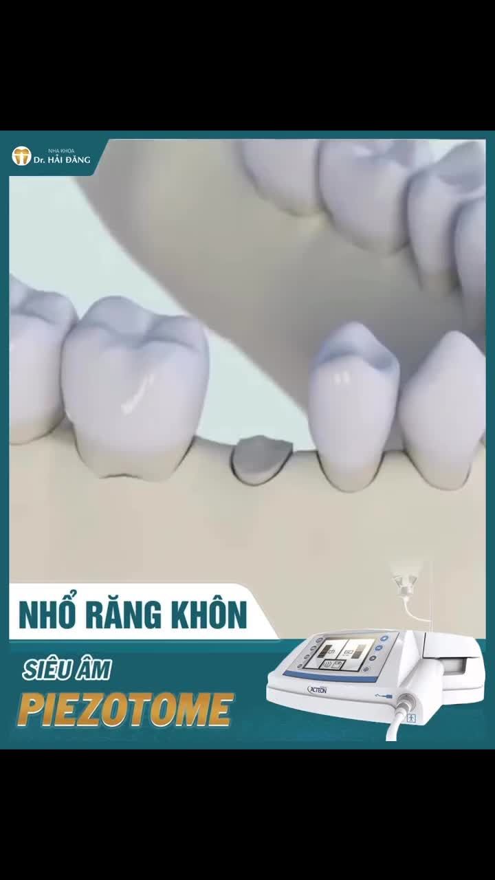 NHỔ RĂNG KHÔN – XỬ LÝ ÊM, NHANH - AN TOÀN