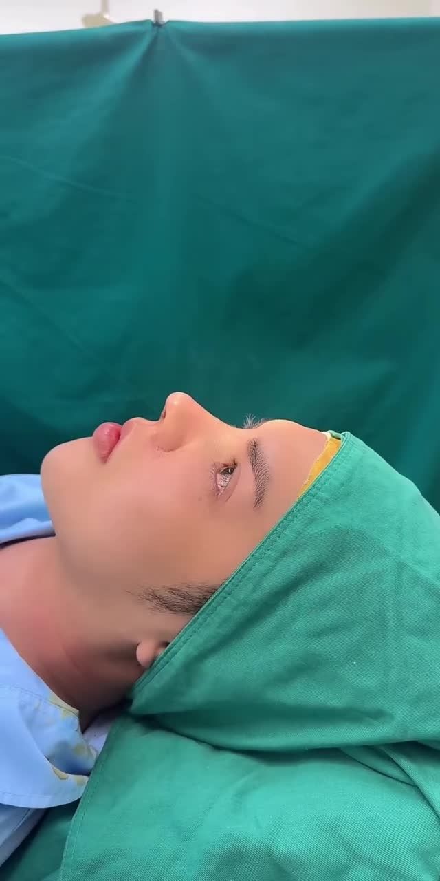 HOÀN THÀNH CA NÂNG MŨI CẤU TRÚC NAM