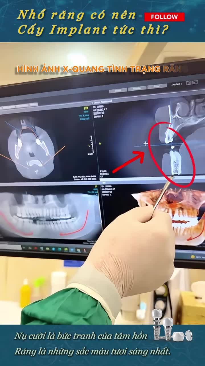 NHỔ CHÂN RĂNG CÓ NÊN CẤY IMPLANT TỨC THÌ? CÂU TRẢ LỜI TỪ BÁC SĨ