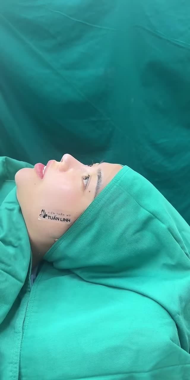 MŨI CẤU TRÚC SURGIFORM – PHƯƠNG PHÁP ƯU VIỆT CẢI THIỆN ĐƯỢC ĐỒNG THỜI NHIỀU KHUYẾT ĐIỂM