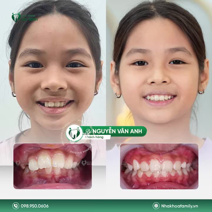 SẮP VÀO NĂM HỌC MỚI - ĐỪNG BỎ LỠ THỜI ĐIỂM VÀNG ĐỂ CHO CON NIỀNG RĂNG!