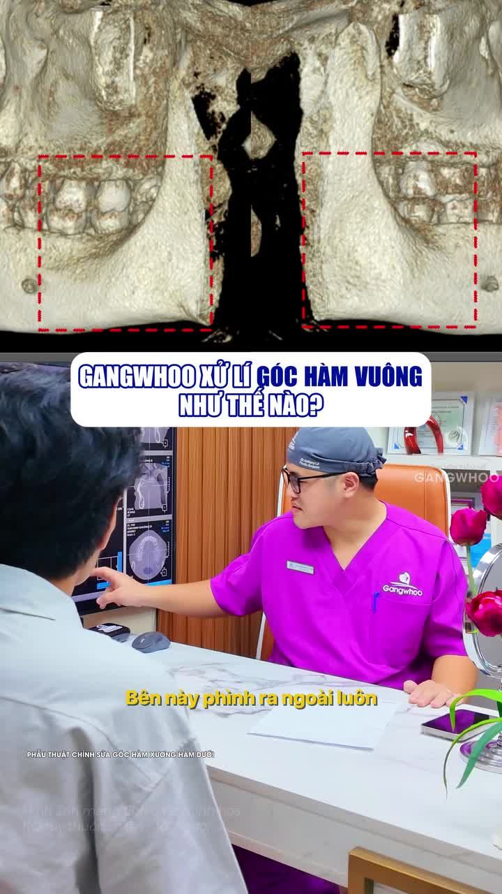 Cùng Bác sĩ tại Bệnh viện thẩm mỹ Gangwhoo xử lý góc hàm vuông cho nam giới như thế nào nhé!