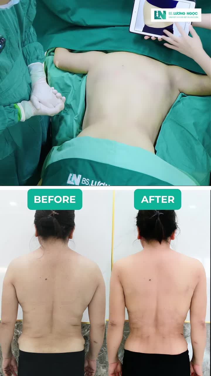 Mỡ tay, lưng, nách "trơ lì"?. Vậy có cách nào xử lý không?