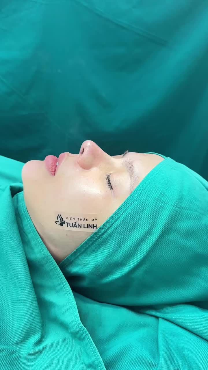 Case mũi tái cấu trúc surgiform vừa hoàn thành