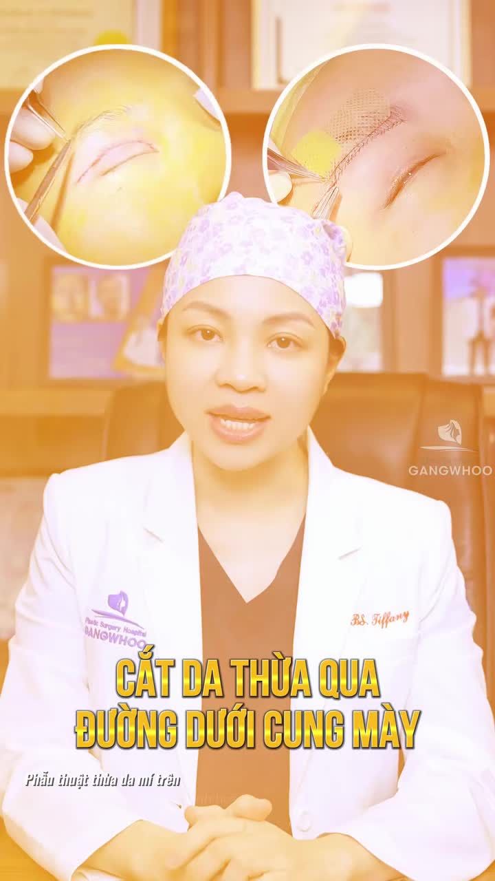 Cắt da thừa qua đường chân mày và cắt da thừa qua điểm mí, đâu là phương pháp phù hợp dành cho bạn