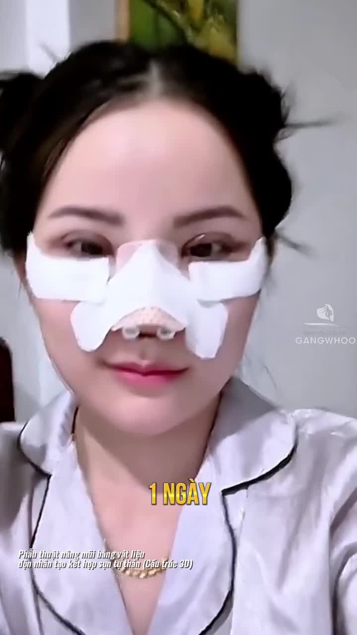 Combo nâng mũi cắt mí sẽ thay đổi bạn như thế nào?