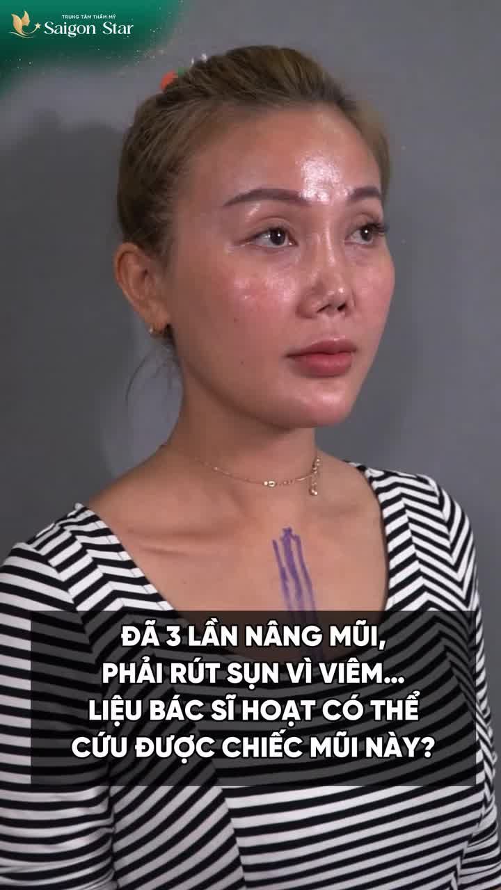 ĐÃ 3 LẦN NÂNG MŨI HỎNG VÀ ĐỀU PHẢI RÚT SỤN, NGỠ LÀ HẾT NHƯNG CUỐI CÙNG PHÉP MÀU CŨNG ĐÃ XẢY RA KHI CHỊ TIN TƯỞNG SAIGON STAR!!!