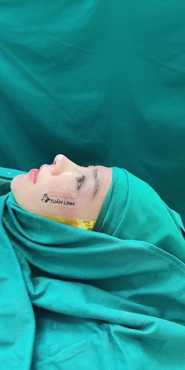 NÂNG MŨI CẤU TRÚC DÁNG S -LINE - KHÁCH HÀNG HÀI LÒNG NGAY SAU KHI MỞ MẮT