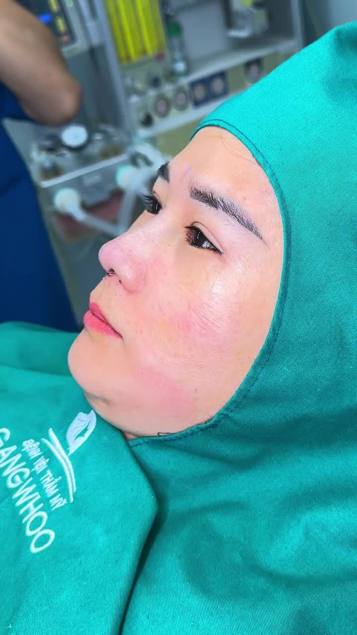 KẾT QUẢ NÂNG MŨI CẤU TRÚC ĐẸP TỰ NHIÊN SAU 60 PHÚT!