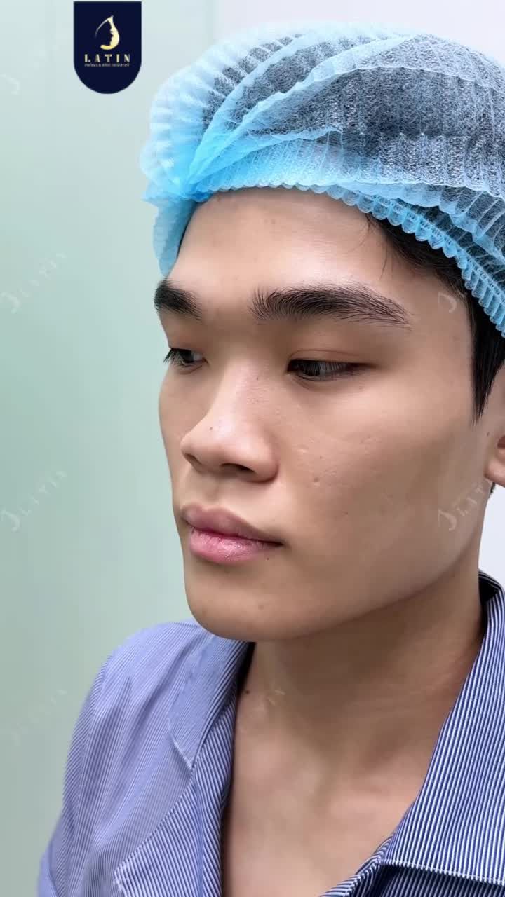 MŨI THẤP, CÁNH MŨI BÈ – LẦN NÀY CẦN XỬ LÝ GÌ?