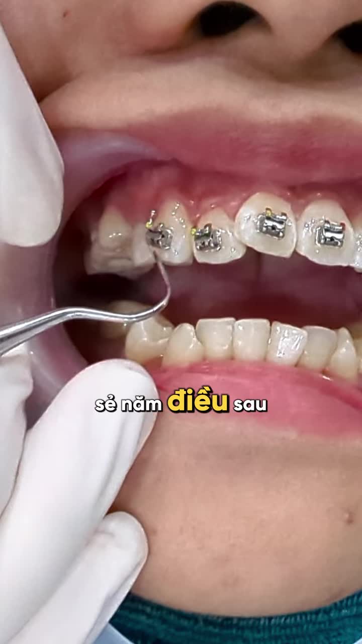 NHỮNG ĐIỀU CẦN BIẾT TRƯỚC KHI NIỀNG RĂNG
