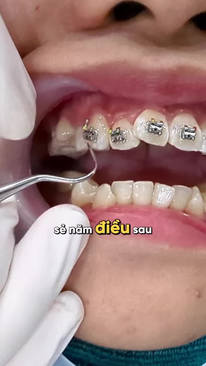 NHỮNG ĐIỀU CẦN BIẾT TRƯỚC KHI NIỀNG RĂNG