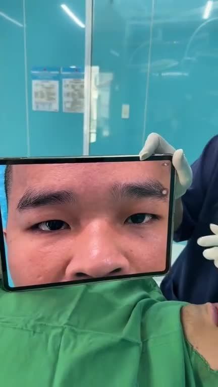 Dr Vương cắt mí trên theo phong cách phù thuỷ Trung Hoa (mí Shanghai-Thượng Hải) nhé các bạn: