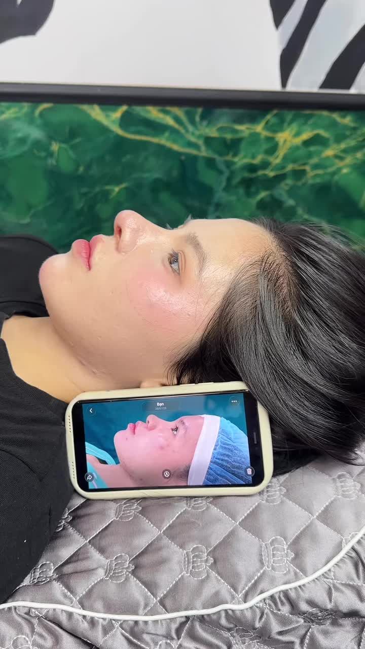 Mũi cấu trúc sau 14 ngày