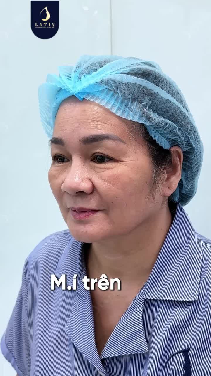 MẮT SỤP THÌ LÀM GÌ CHO GƯƠNG MẶT TƯƠI HƠN?