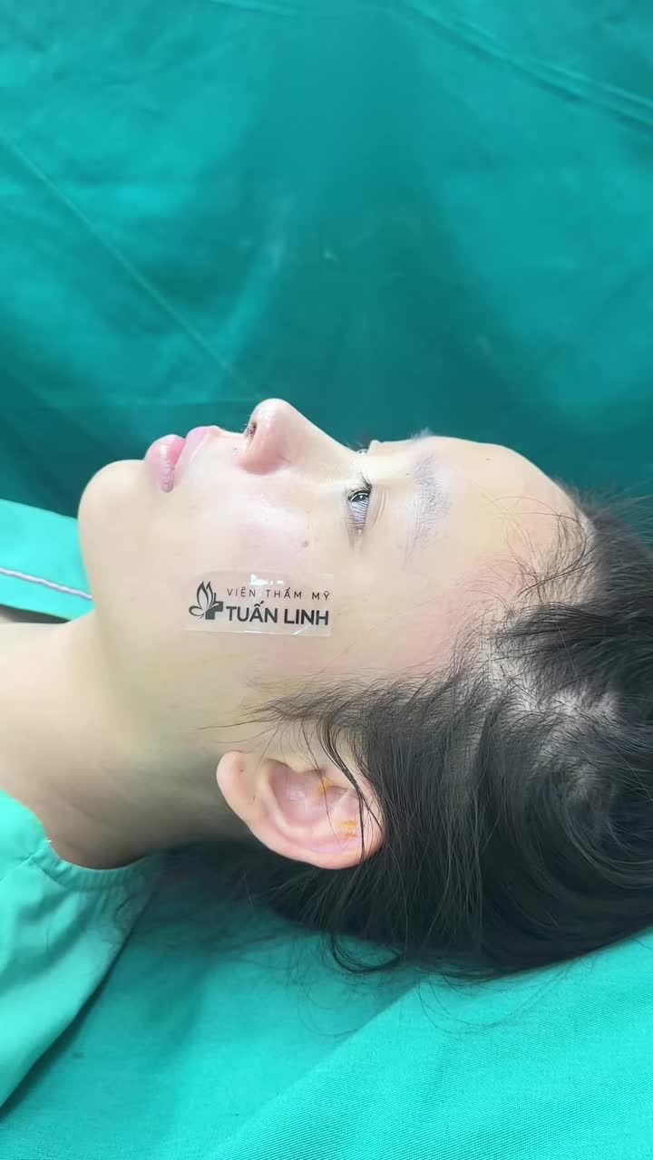 Mũi cấu trúc sau phẫu thuật