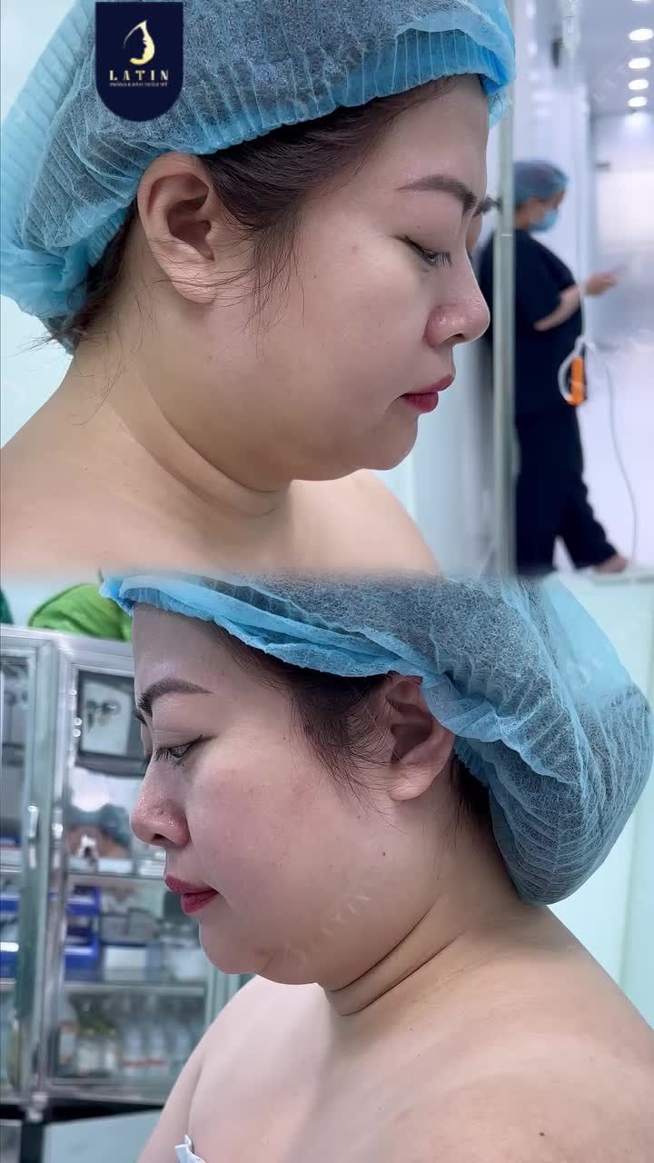 HÚT MỠ NỌNG CẰM  "ĐÁNH THỨC GÓC NGHIÊNG - TẠO NÉT CẰM THANH"