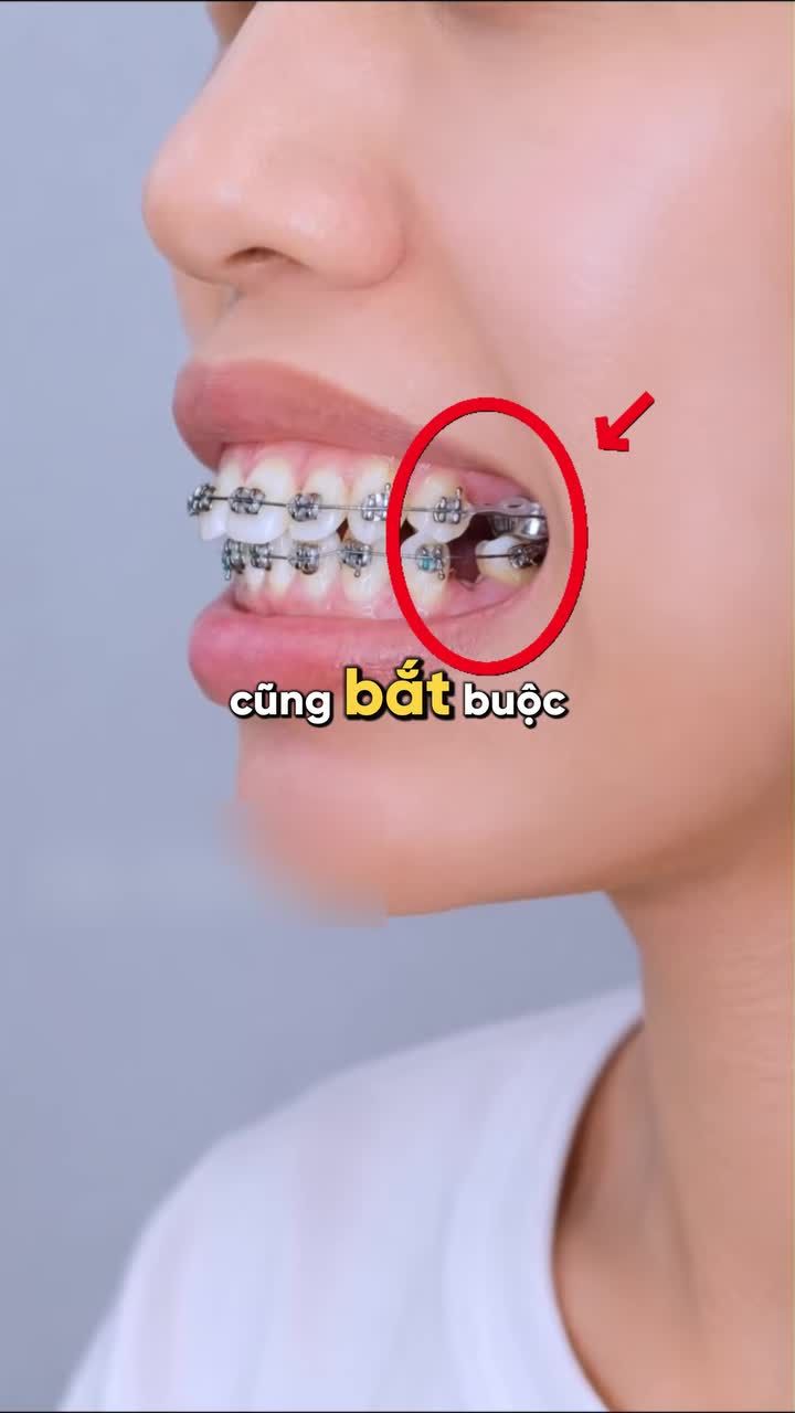 NIỀNG RĂNG CÓ BẮT BUỘC PHẢI NHỔ RĂNG KHÔNG?