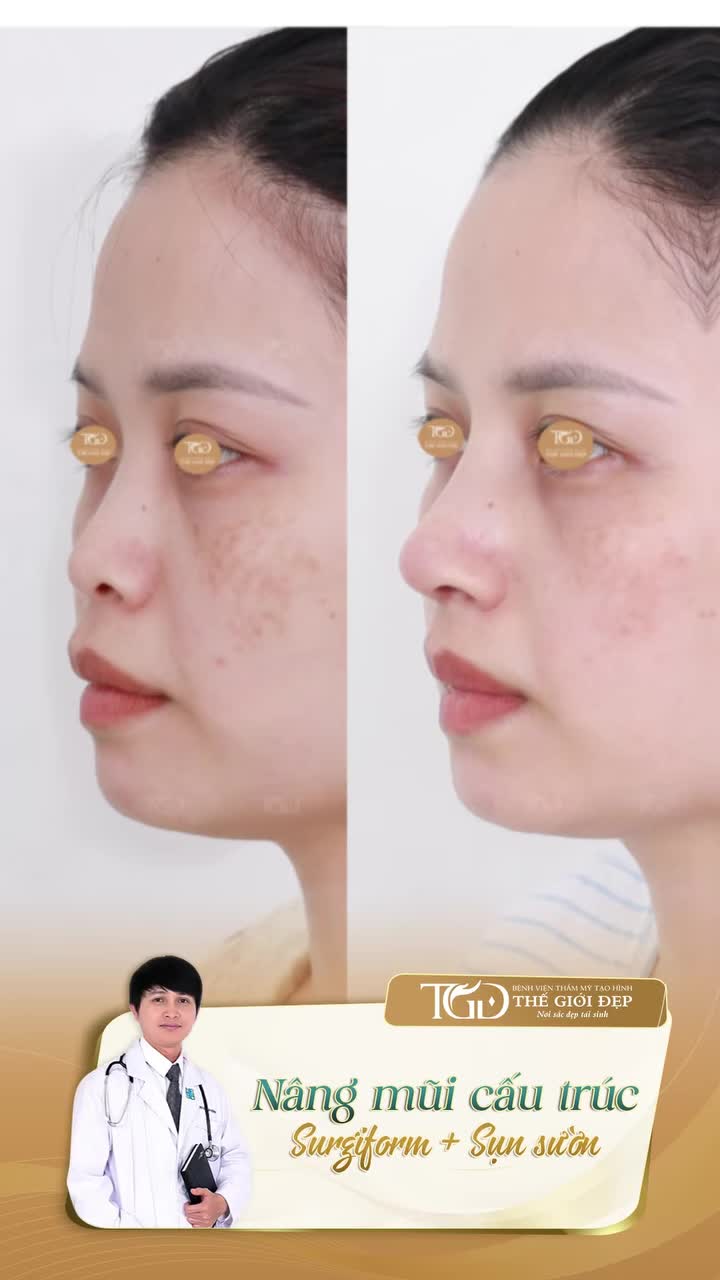 Sở hữu góc nghiêng thần thái – Bí quyết nằm ở tỷ lệ dáng mũi chuẩn