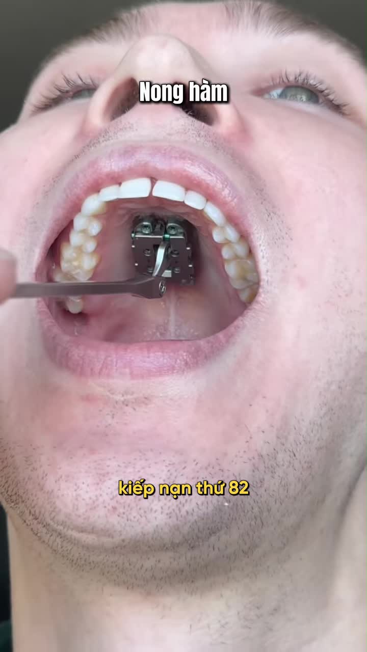 Kiếp nạn nong hàm