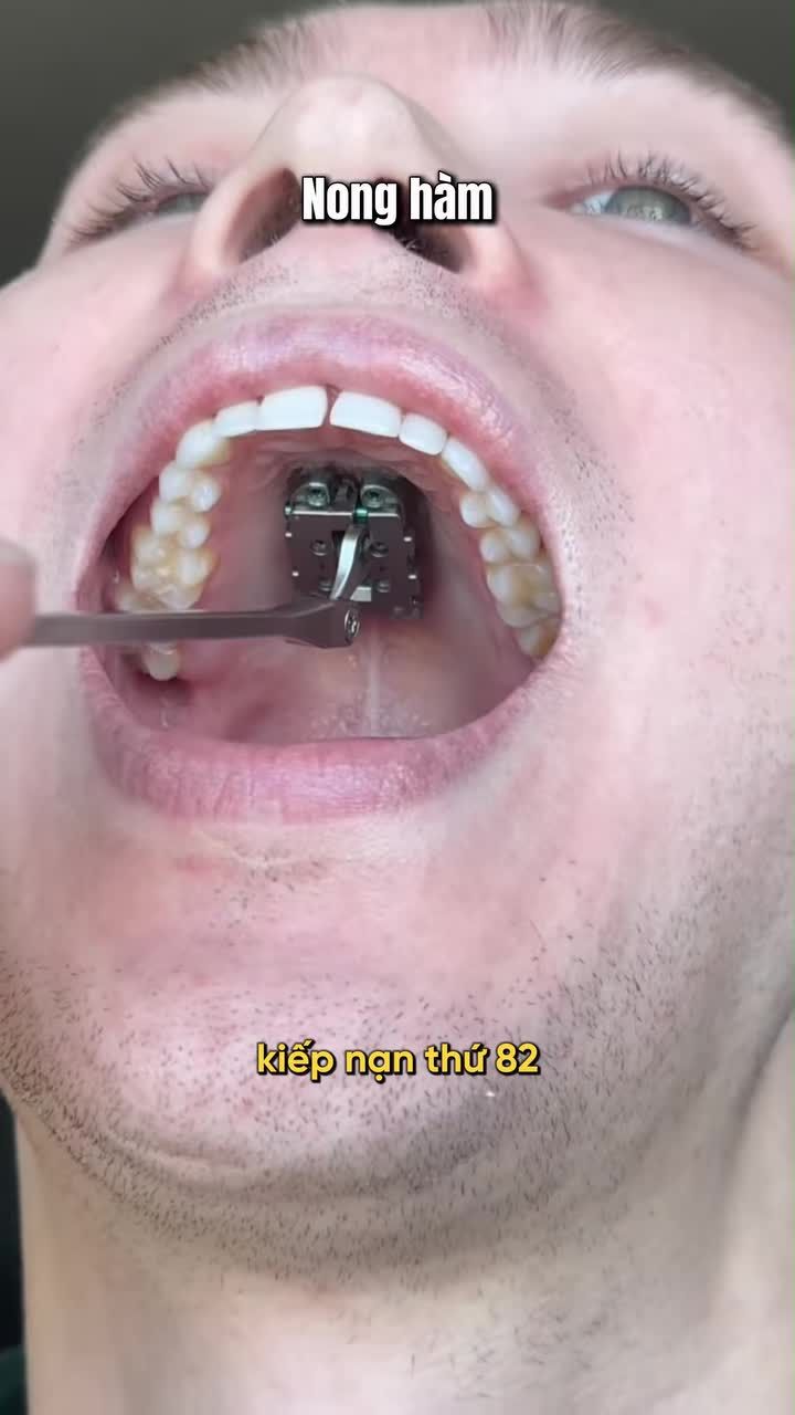 Kiếp nạn nong hàm