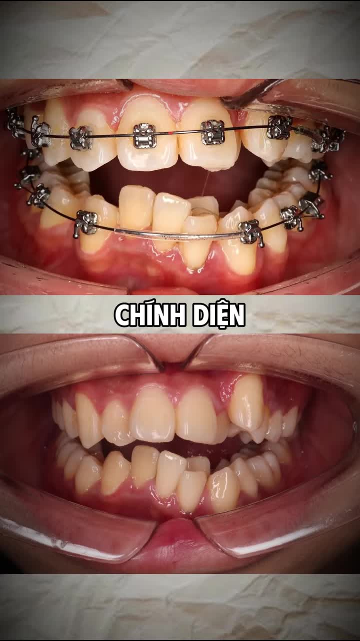 Tình trạng: Răng khấp khểnh hai hàm, chen chúc, lệch đường giữa và sai khớp cắn, cần nhổ răng để tạo khoảng sắp đều.