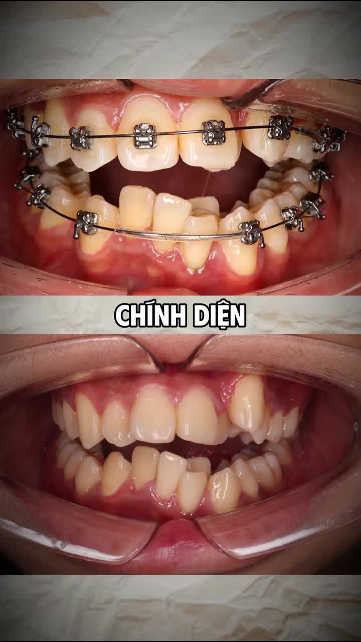 Tình trạng: Răng khấp khểnh hai hàm, chen chúc, lệch đường giữa và sai khớp cắn, cần nhổ răng để tạo khoảng sắp đều.