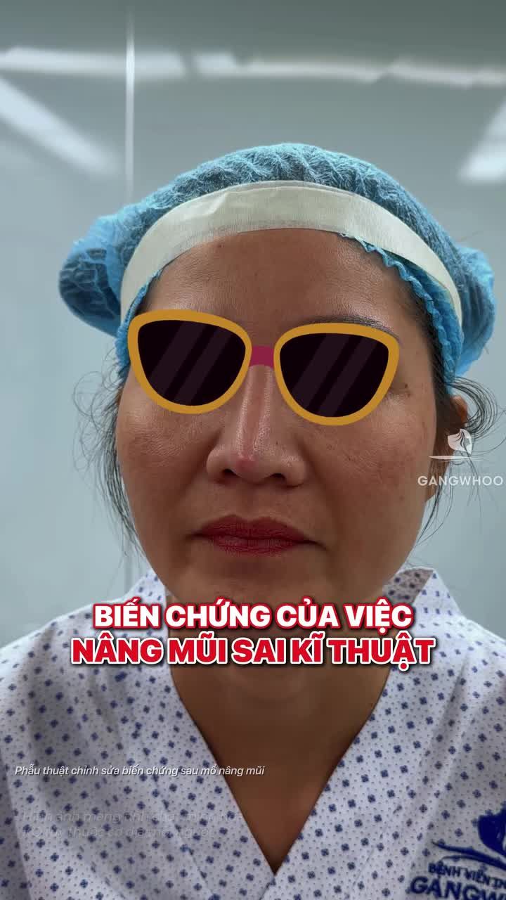 Sụn lắc lư dưới da hậu quả của việc nâng mũi sai kỹ thuật