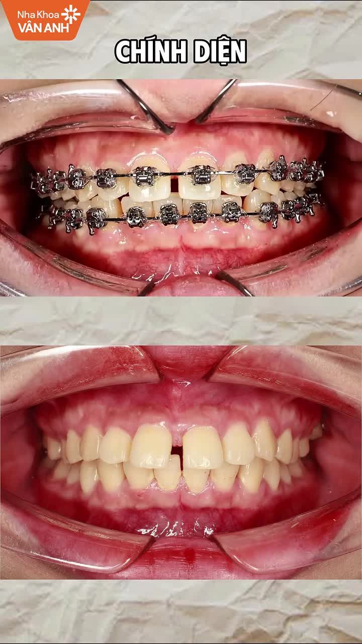Tình trạng: Răng khấp khểnh hai hàm, cắn chéo vùng răng hàm, sai khớp cắn.