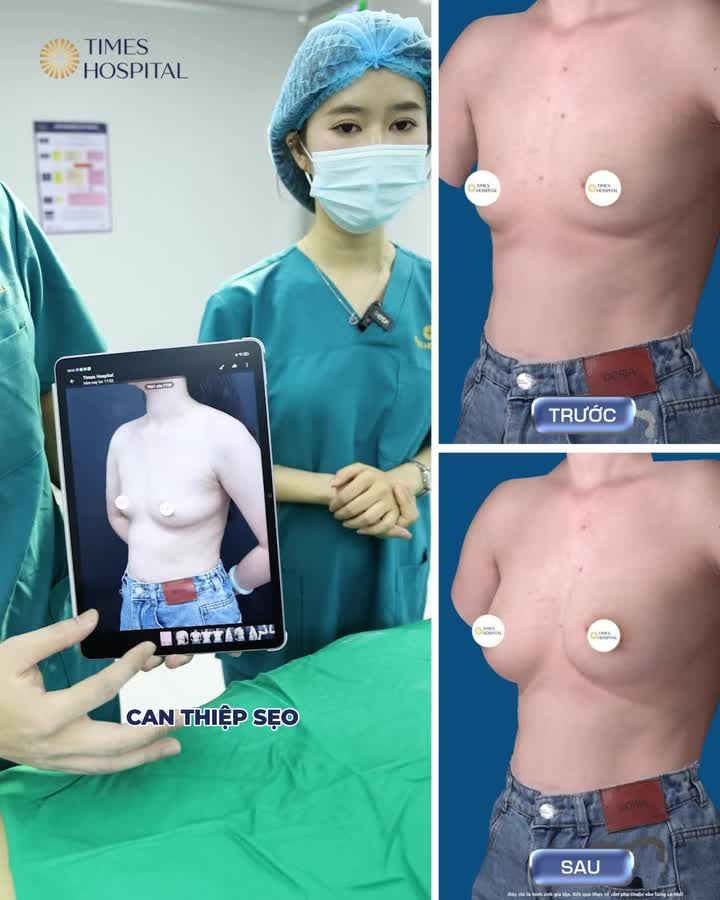 NGỰC SA TRỄ NHẸ THÌ CÓ CẦN TREO SA TRỄ?