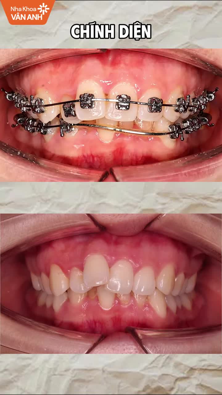 Tình trạng: Răng khấp khểnh hai hàm, có khe thưa, cắn sâu và sai khớp cắn, đường giữa hàm dưới lệch.