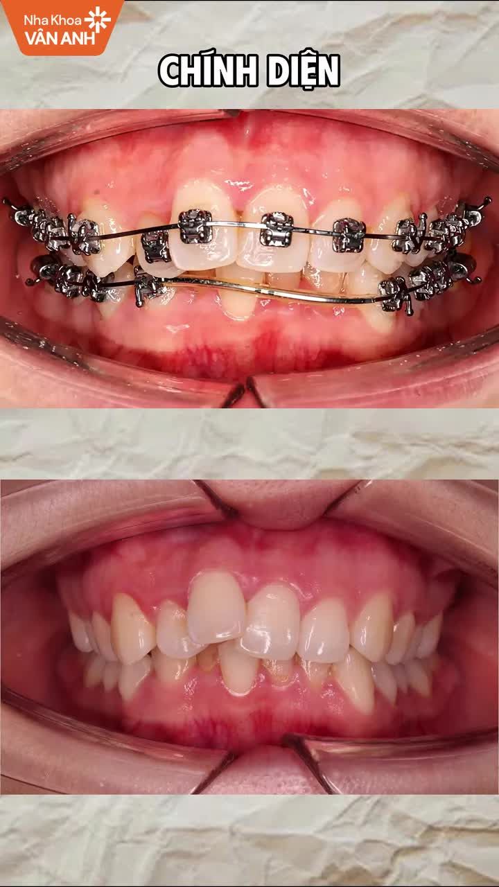 Tình trạng: Răng khấp khểnh hai hàm, có khe thưa, cắn sâu và sai khớp cắn, đường giữa hàm dưới lệch.
