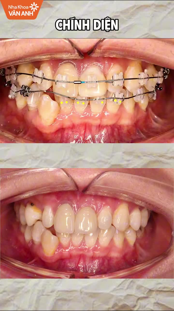 Răng khấp khểnh hai hàm, có khe thưa, sai khớp cắn và lệch đường giữa, cần kéo lùi nhóm răng trước và tinh chỉnh khớp cắn.