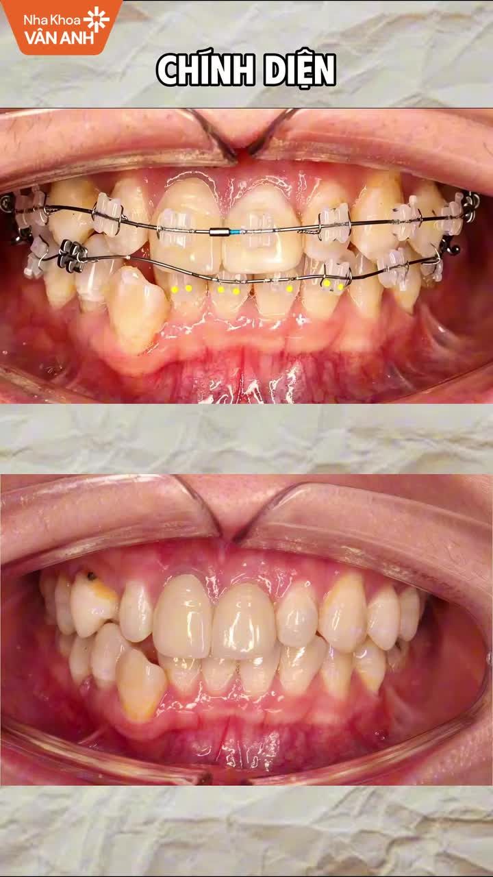 Răng khấp khểnh hai hàm, có khe thưa, sai khớp cắn và lệch đường giữa, cần kéo lùi nhóm răng trước và tinh chỉnh khớp cắn.