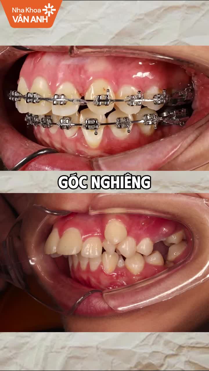 Tình trạng: Cung hàm hẹp, răng khấp khểnh, răng hàm dưới nghiêng ngoài và có răng thừa, răng kẹt vùng răng cửa trên.