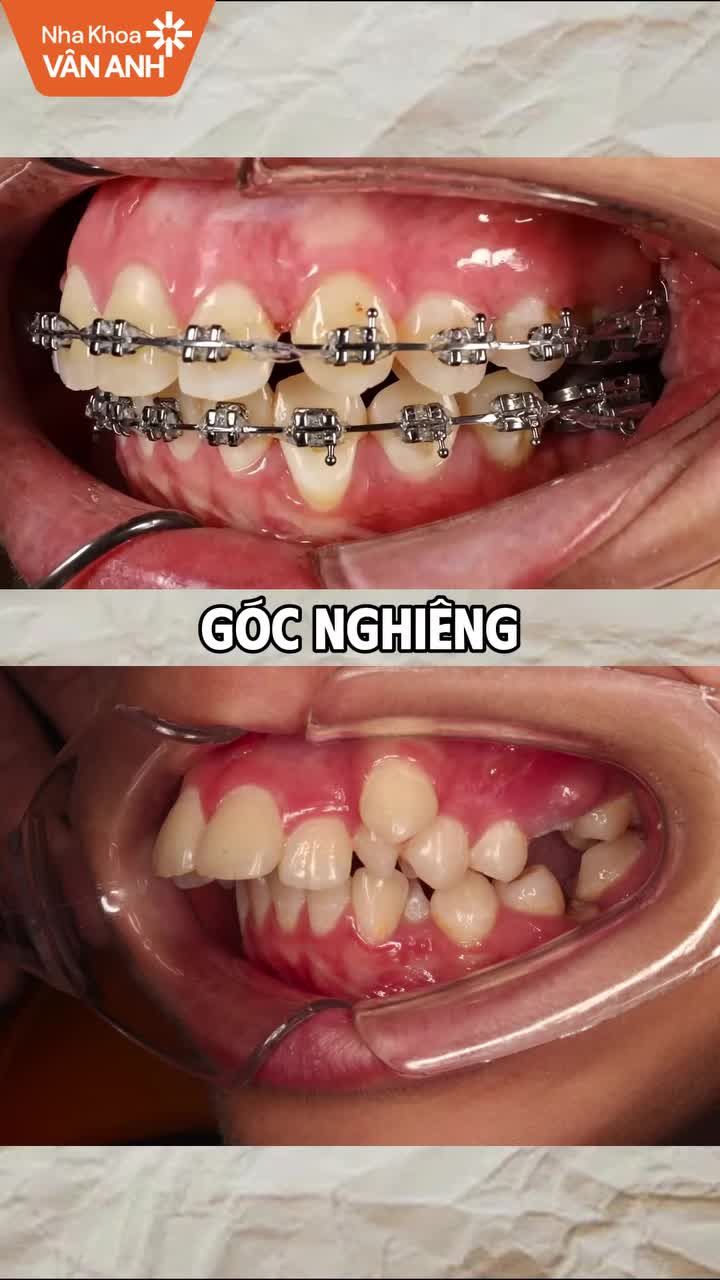 Tình trạng: Cung hàm hẹp, răng khấp khểnh, răng hàm dưới nghiêng ngoài và có răng thừa, răng kẹt vùng răng cửa trên.