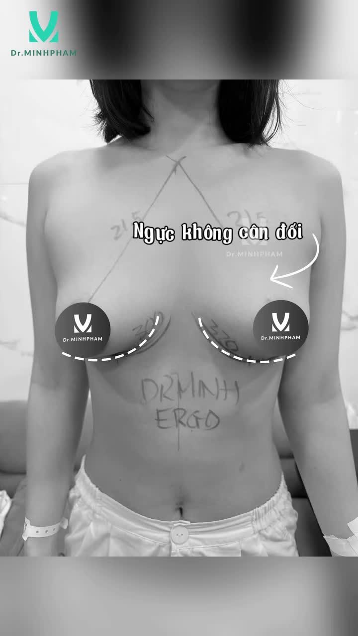 Lựa chọn nâng cấp V1 Ergo tại Dr. Minh Phạm để sở hữu ngay dáng ngực cân đối, mềm mại khi chạm, tự nhiên trong từng chuyển động và hài hòa với vóc dáng