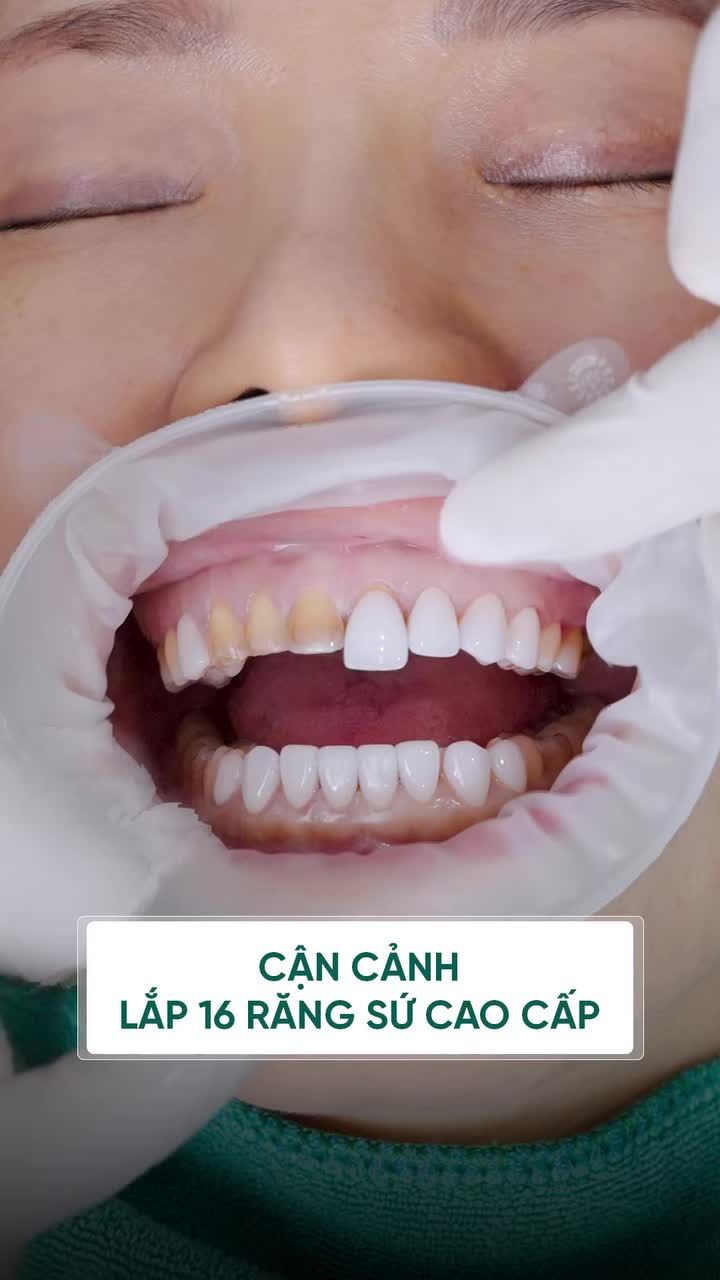 BẮT TRỌN KHOẢNH KHẮC CẬN CẢNH LẮP RĂNG SỨ TẠI DELIA!