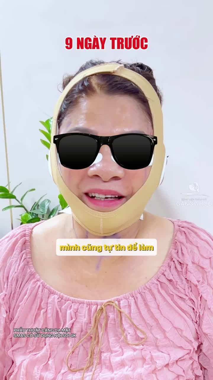 Kết quả sau 10 ngày thực hiện căng da mặt toàn phần Smas có sử dụng nội soi 4K khiến khách hàng vui vẻ hài lòng và không đau.