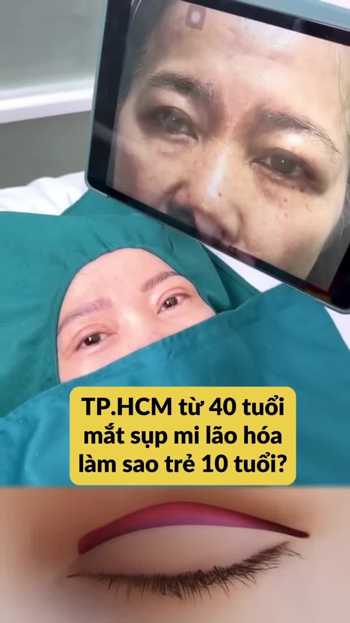 CHỊ EM 40 TUỔI TP.HCM CHÚ Ý: XOÁ SẠCH SỤP MI LÃO HOÁ, MẮT TRẺ 10 TUỔI VỚI TRẺ HOÁ MẮT TẠI JW