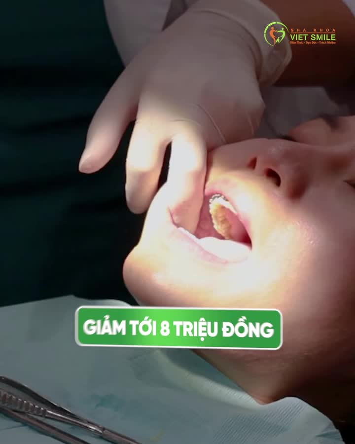 Niềng răng giảm sâu – Quà tặng ngập tràn chính thức mở màn tại Viet Smile!