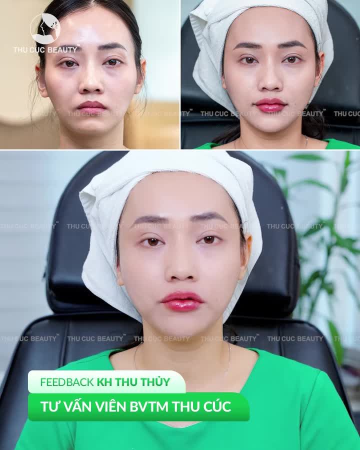FILLER TC CHỈ TỪ 3TR/CC CÓ NGAY GƯƠNG MẶT BABY NHƯ Ý