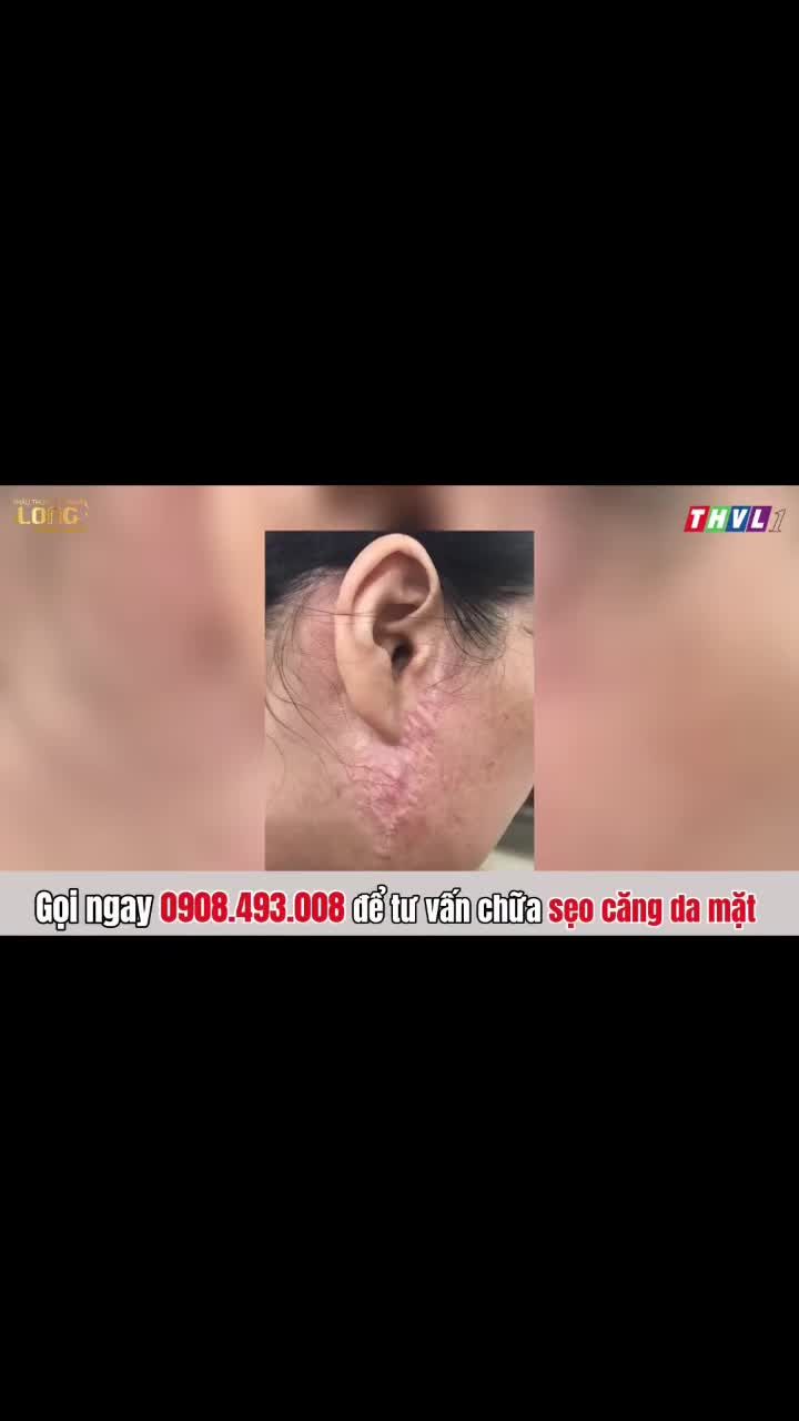 Vì sao cùng căng da mặt nhưng người trẻ đẹp rạng ngời, người lại bị "sẹo xấu" kém thẩm mỹ?