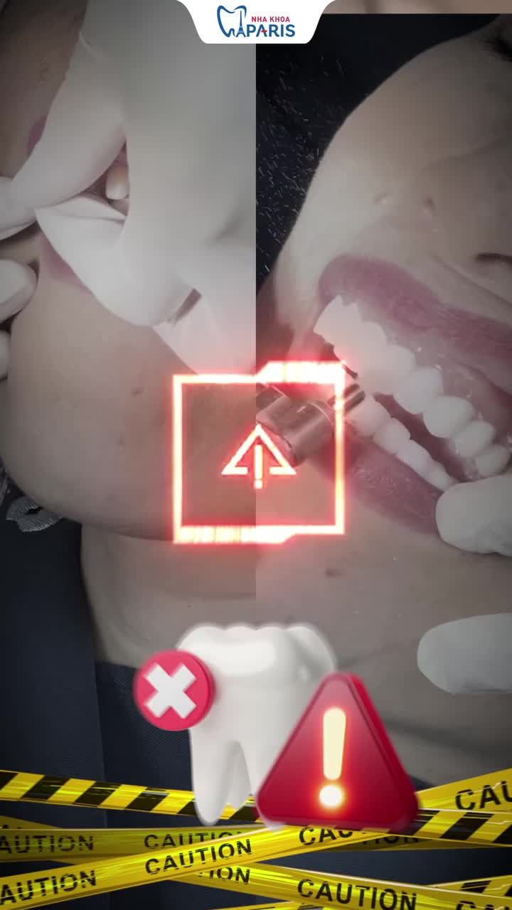 Xem thêm 624 video Bọc Răng Sứ của bác sĩ Bs nha khoa Paris