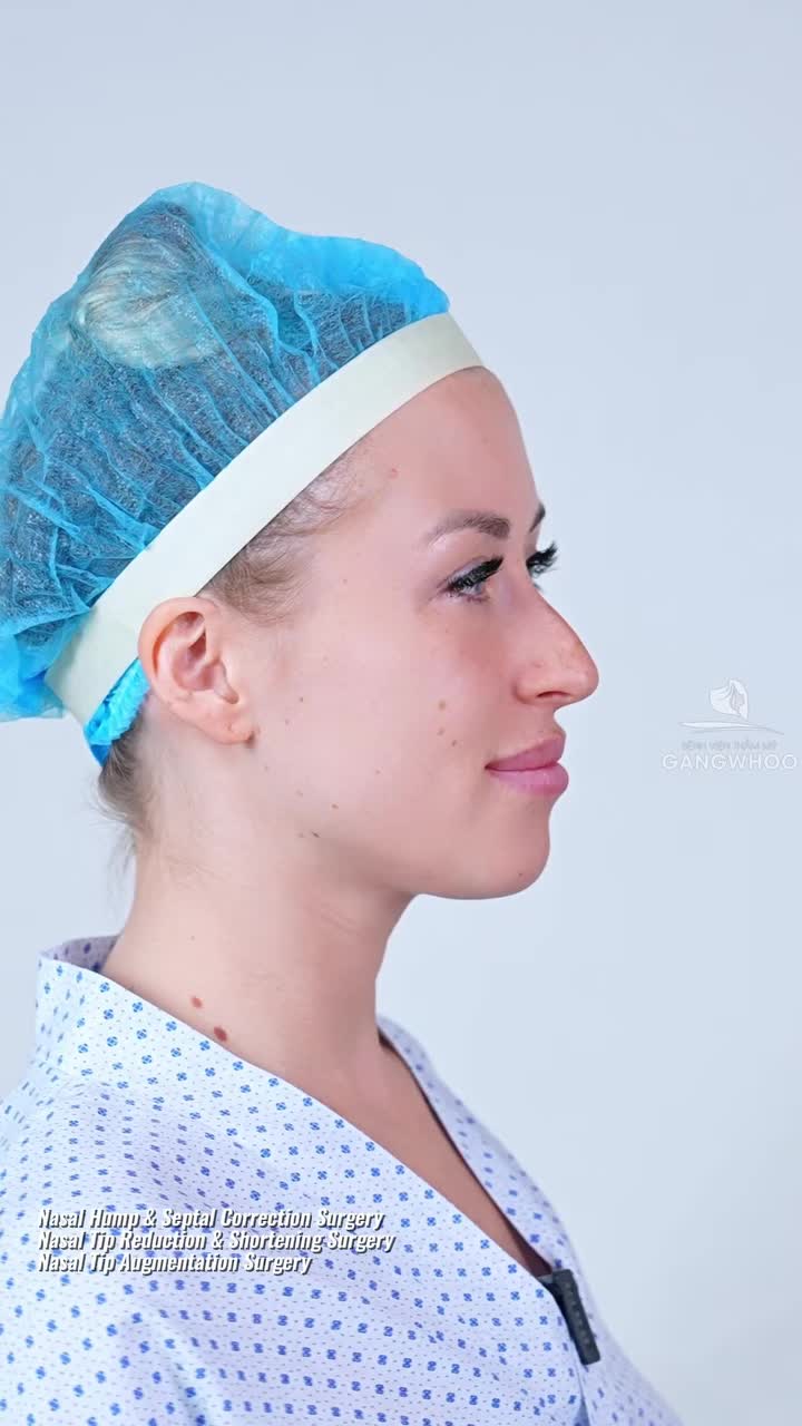 Combo mài gồ + thu nhỏ đầu mũi + dựng trụ cho chị khách hàng Nga