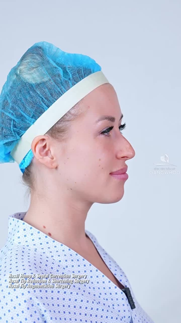 Combo mài gồ + thu nhỏ đầu mũi + dựng trụ cho chị khách hàng Nga