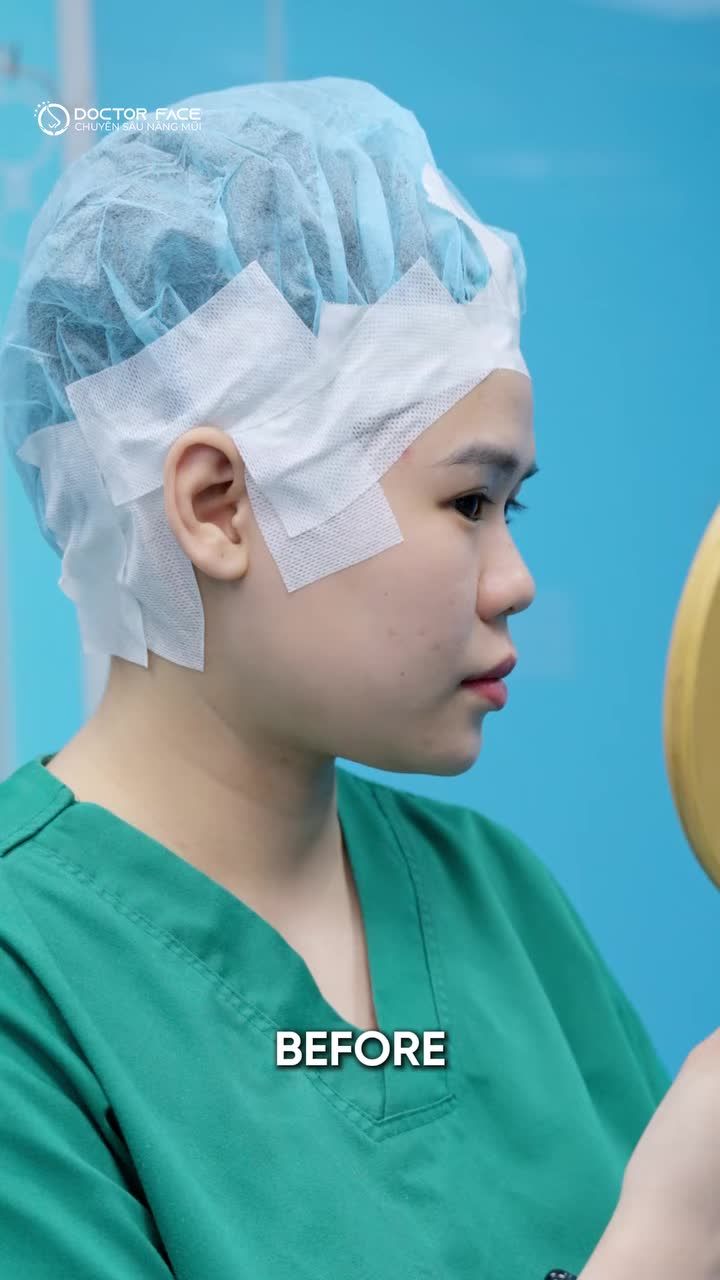 Từng chọn filler vì sợ nâng mũi sẽ “quá nhiều” với mình  Đến lúc làm thật mới thấy, có những nỗi sợ mình đã giữ lâu hơn cần thiết